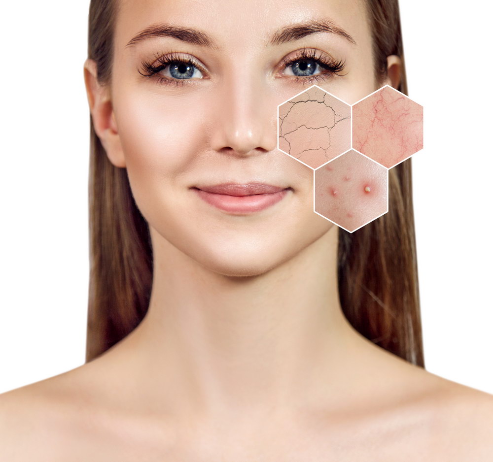 Zoom hexagon shows skin problems with couperose and acne.